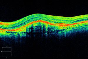 homogénea, hipofluorescente (resultado do efeito máscara do líquido subretiniano).