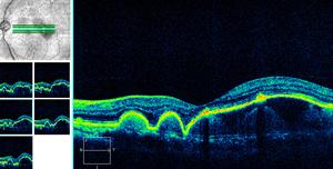 Fig. 48 DESCOLMENTO DRUSENOIDE e B Retinografia Drusens serosos confluentes.