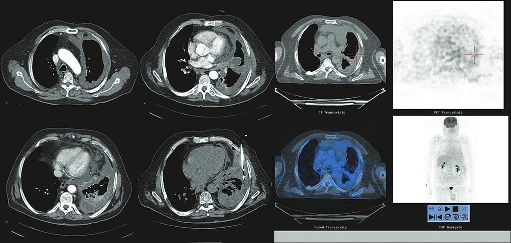 XXIII Congresso de Pneumologia / TEXTOS O MPM é um tumor raro, fortemente associado aos asbestos S 98 Fig.