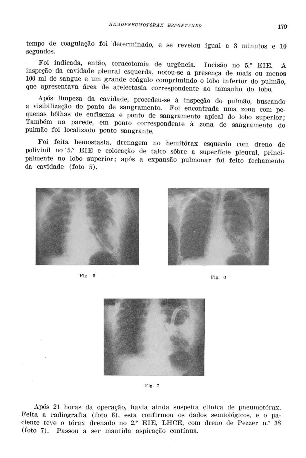 HEMOPNE UM O TÓRAX ESPONTÂNEO 179 tempo de coagulação foi 'determinado, e se revelou igual a 3 minutos e 10 segundos. Foi indicada, então, toracotomia de urgência. Incisão no 5. 9 EIE.