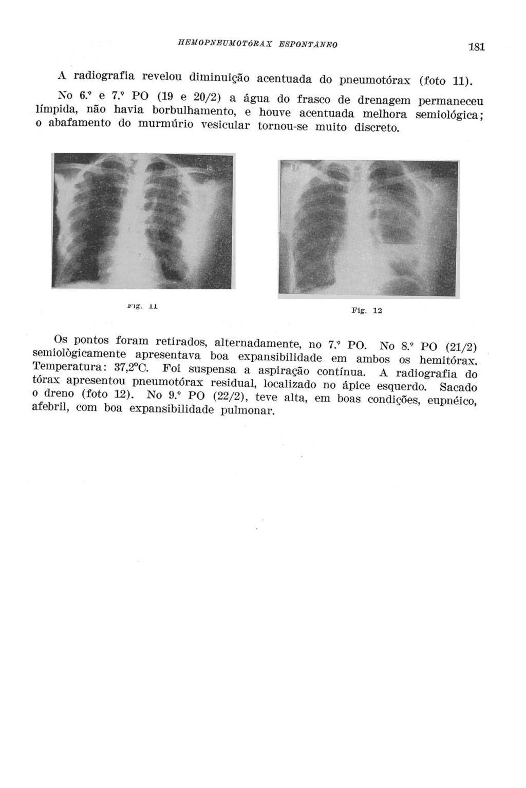 HEMOPNEUMOTÓRAX ESPONTÂNEO 181 A radiografia revelou diminuição acentuada do pneumotórax (foto 11). No 6.* e 7.