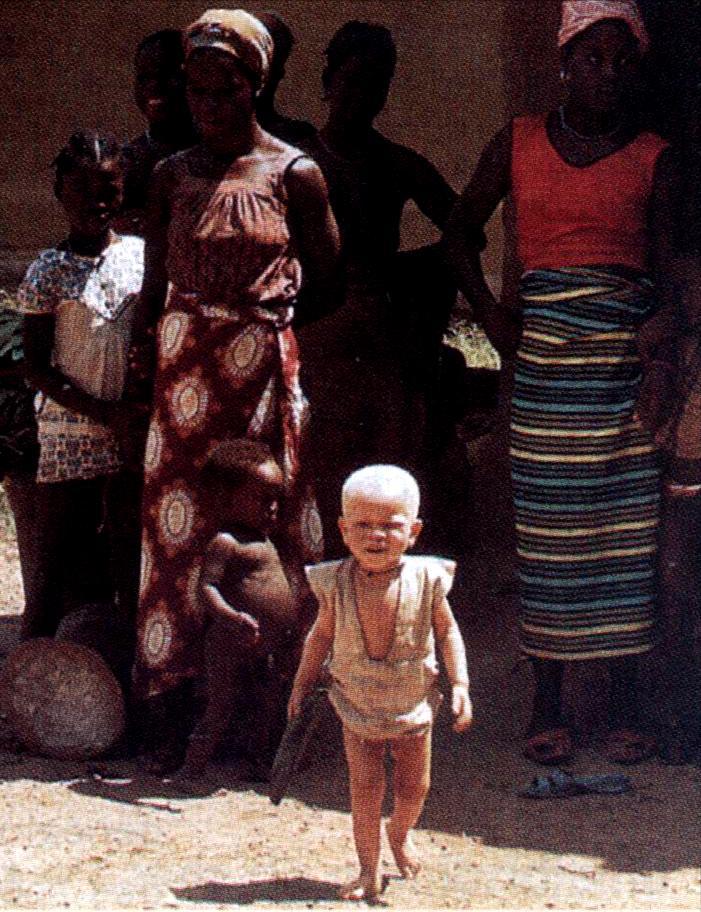 O albinismo é uma doença rara, com caráter hereditário, que resulta da incapacidade de produzir um pigmento chamado melanina.