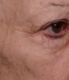 wrinkles de ruga volume profunda (%) Rugosidade Roughness (µm) (µm) 0 Antes Após 6 semanas -5-4,9%*** -10-15 -20-16.