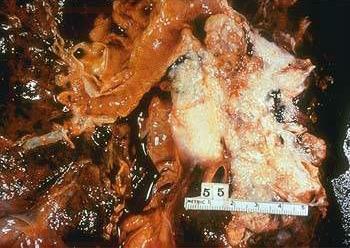 Características clínicas das neoplasias malignas Brônquio,carcinoma Macroscopia,superfície de corte Obrônquio está obliterado por uma grande massa branco-acastanhada com bordas infiltrativas.