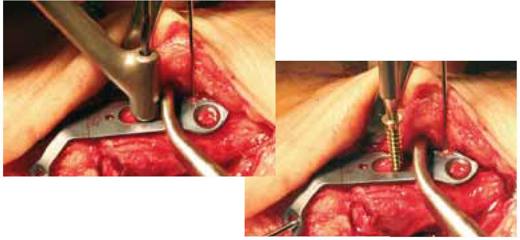 7 - Fixação Provisória em Artrodese Um fio de Kirschner de 1,5 mm é