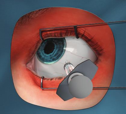 Informe os doentes de que poderão ter: Olho congestionado causado por hemorragia de pequenos vasos sanguíneos das camadas externas do olho (hemorragia conjuntival) Manchas móveis na