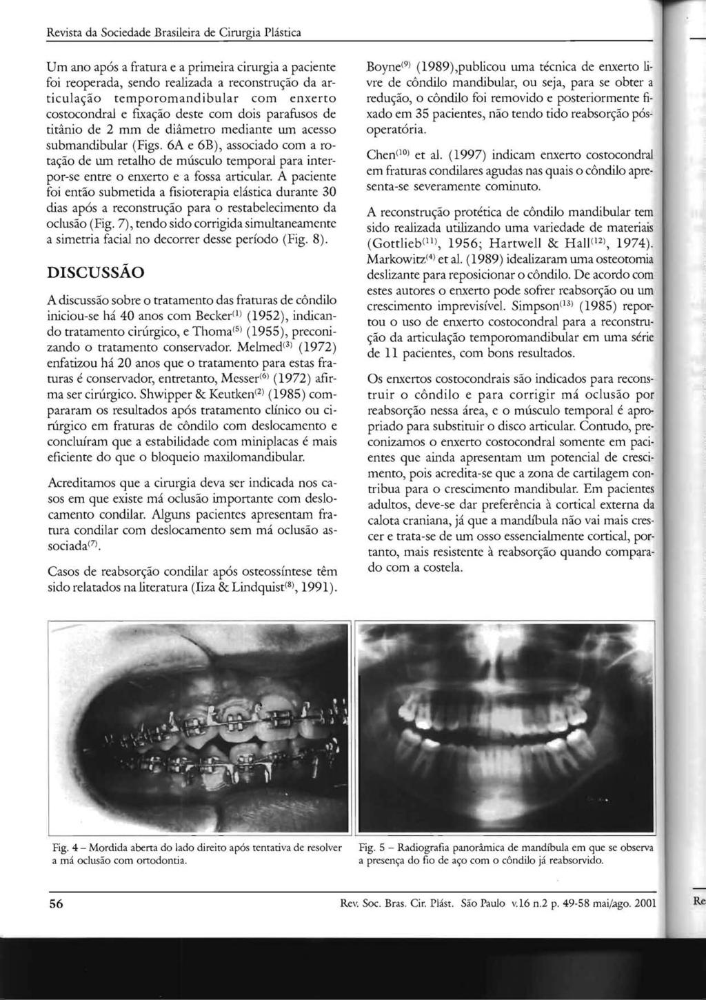 Revista da Sociedade Brasileira de Cirurgia Plastica Urn ano ap6s a fratura e a primeira cirurgia a paciente foi reoperada, sendo realizada a reconstru<;ao da articula<;ao temporomandibular com