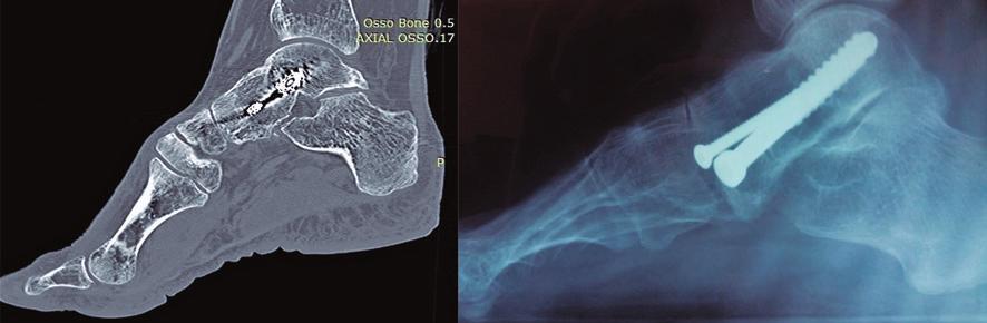 Avaliação do resultado e da consolidação das artrodeses do retropé utilizando radiografia simples versus tomografia computadorizada 43 Figura 3 Exemplo de consolidação completa da articulação
