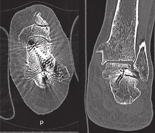 DISCUSSÃO O uso de artrodeses mais limitadas no retropé foi facilitado pelo emprego da tomografia computadorizada e ressonância magnética nuclear, as quais podem demonstrar mais precisamente quais