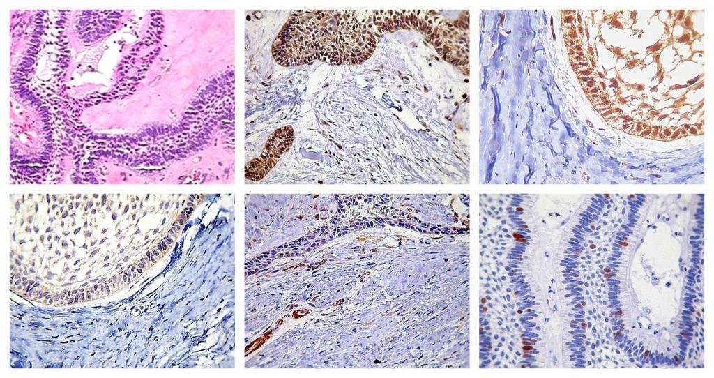 55 A B C D E F Figura 1: Análise histopatológica e imunoistoquímica do ameloblastoma sólido. Análise histopatológica (HE, 400X): A) Ilhotas de epitélio odontogênico dentro de um estroma fibroso.