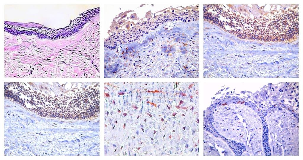 57 A B C D E F Figura 2: Análise histopatológica e imunoistoquímica do ameloblastoma unicístico.