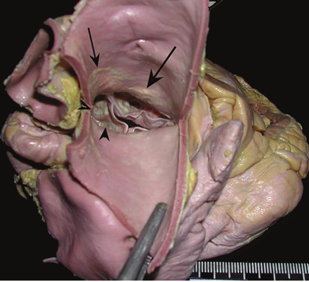 Fig. 2 - Placas ateroscleróticas discretas na aorta ascendente (seta) e na valva aórtica (cabeça de seta) em paciente idoso portador de cardiopatia chagásica crônica. Fig.