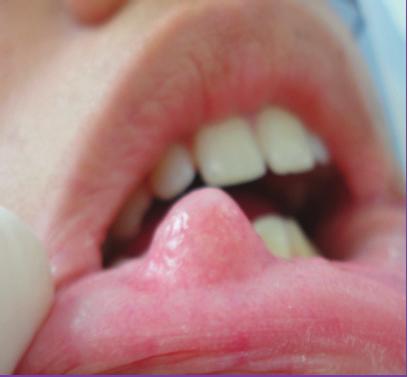 Figura 1 Vista ântero-lateral da lesão localizada em lábio inferior do lado direito.