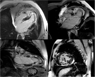 Figura 3 Imagens de realce tardio em eixos longos e curto do coração com extensa fibrose (áreas brancas em contraste com o miocárdio "sadio"
