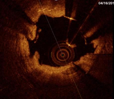 A dissecção foi considerada importante se a faixa de dissecção apresentasse distância >200 µm da parede do vaso e se estendesse por >600 µm longitudinalmente.