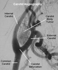 Artérias carótidas interna e externa BULBO