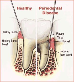 DOENÇAS PERIODONTAIS gengivite crônica e aguda - gengivite crônica necrotizante ulcerativa - periodontite