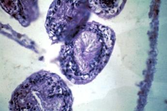 Hidátide de Echinococcus