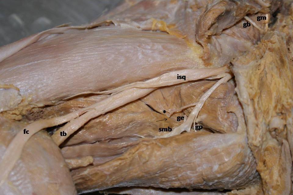 Figura 2 Fotografia da face dorsal do membro pélvico esquerdo de Procyon cancrívorus, observam-se ramos do nervo isquiático (isq) para os músculos glúteo médio (gm),