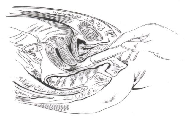 Figura 7. Ilustração da posição da sonda no canal vaginal.