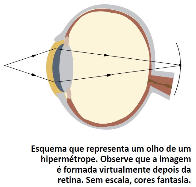 Hipermetropia: Dificuldade de enxergar objetos que estão próximos; Nesse caso, a imagem