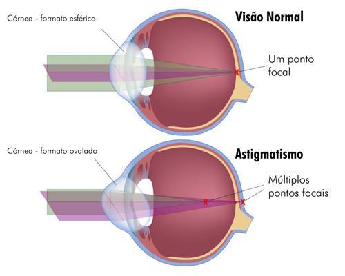 Astigmatismo: Diferença nas curvaturas da córnea e da lente;