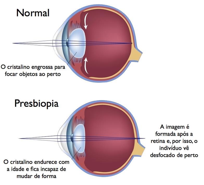 Presbiobia: Enrijecimento dos músculos que regulam a lente; Vista