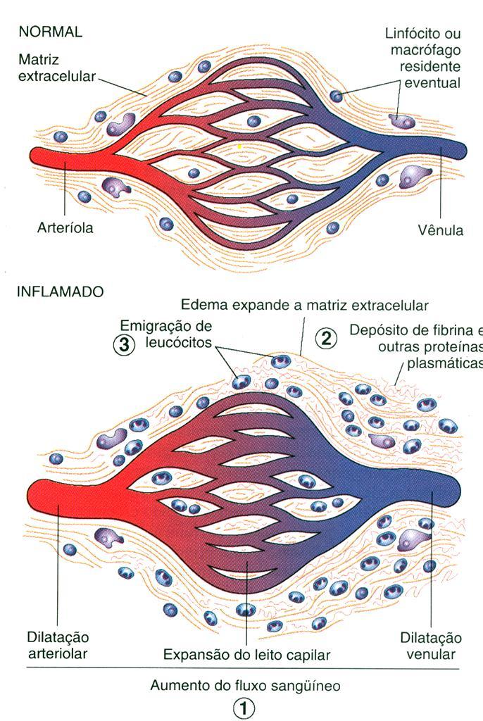 Fase Exsudatva: Exsudato Inflamatório,