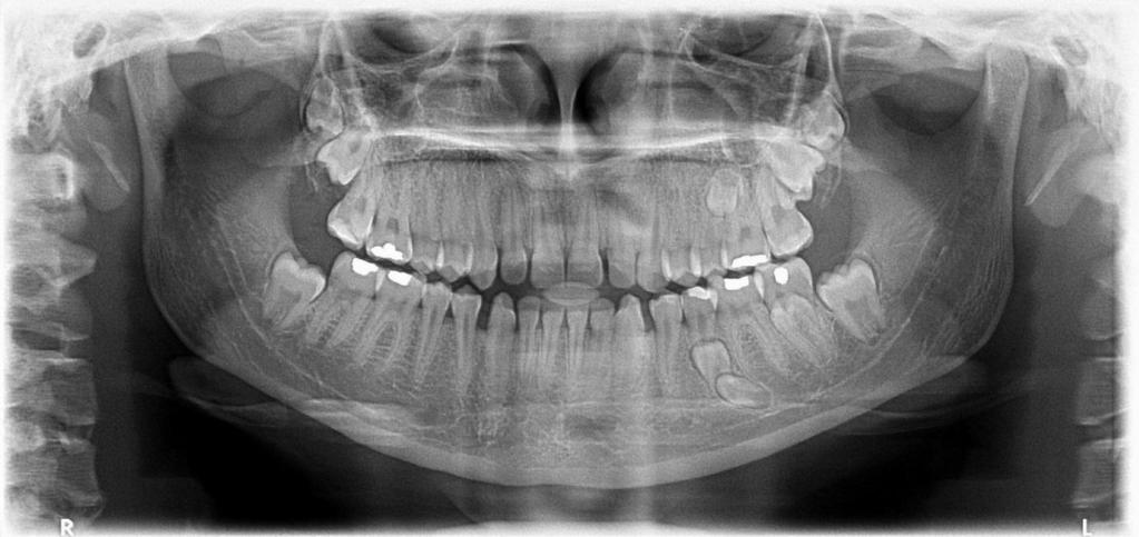 12 2.5.2. Região De acordo com Sharma e Singh (2012), em relação à distribuição e à localização, as áreas mais afetadas foram a região posterior da maxila (35%) e a região posterior da mandíbula (35%).