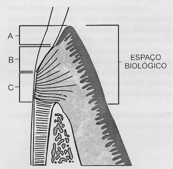 20 Fig. 3 Espaço biológico do peridonto: A sulco gengival; B epitélio juncional; C inserção conjuntiva (copiado de BLOCK, 1987).