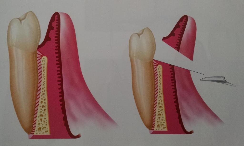 26 Fig. 5 Representação esquemática da incisão para gengivoplastia, com remoção de tecido gengival. (copiado de DUARTE; CASTRO; PEREIRA, 2009).