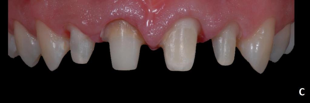 restaurar o elemento dental. Fig 21. Aspécto final com coroas. (KANO; BARATIERI; GONDO, 2010).