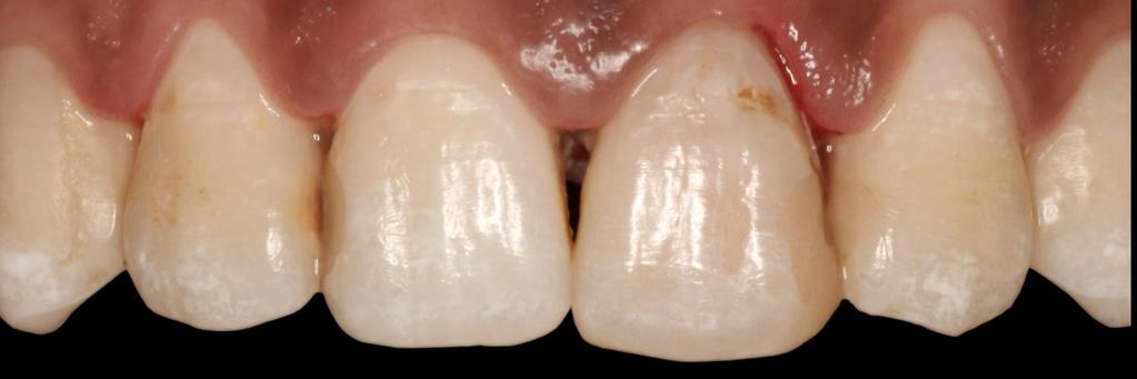 suas propriedades para não prejudicar a saúde periodontal do paciente (POLETTO, 2011).