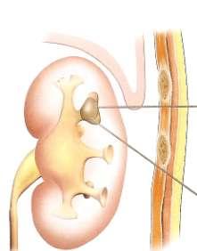 LECO Cálculos em ureter proximal não impactados Cálculos renais até 1,5cm Entre 1,5 e 2,0cm aconselhável passar duplo J antes Chance