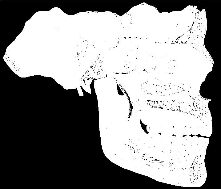 NERVO MISTO Ramo mandibular - sensorial: pele 1/3 inferior face, músculos, mandíbula, soalho bucal, metade inferior mucosa jugal, dentes inferiores, gengiva