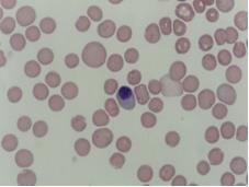 Anisocitose Regeneração anemias ferroprivas