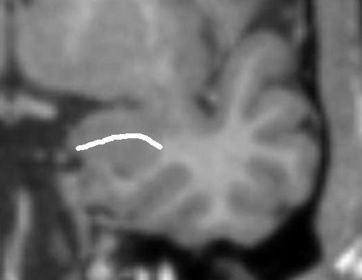 Metodologia 64 Figura 10: Corte de ressonância magnética coronal, ponderado em T1, mostrando o alveus do hipocampo, que divide esta estrutura da amígdala.