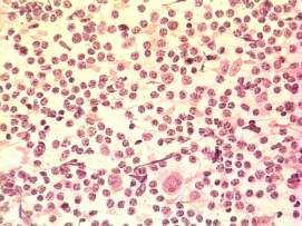 LH-c: celularidade mista Padrão difuso Raros foliculos residuais Granulomas epitelióides