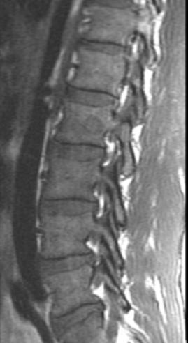 Meningite