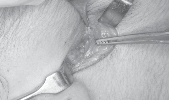 Marcação da linha de incisão, iniciando 0,5 a 1 cm inferior à implantação do lóbulo da orelha seguindo por 2,5 a 3,5 cm em linha paralela e 0,5 a 1 cm posterior ao bordo posterior da mandíbula; 5.