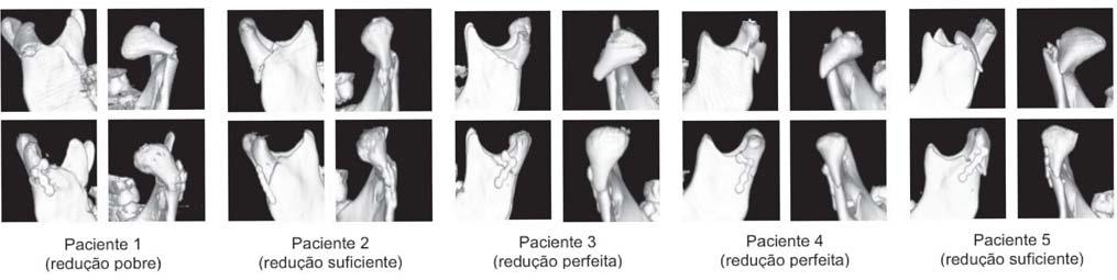 Bastos EO et al. Controle radiológico da redução As tomografias pós-operatórias mostraram redução perfeita em 6 pacientes, satisfatória em 3 e pobre em 1 (Figura 7).