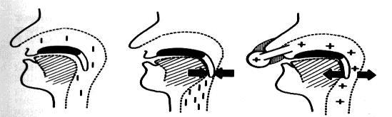 CPAP (Continuous Positive Airway Pressure) padrão ouro para o tratamento da SAOS moderada a acentuada Caso 2: Polissonografia SPLIT NIGHT CPAP-------------------------- Hipnograma