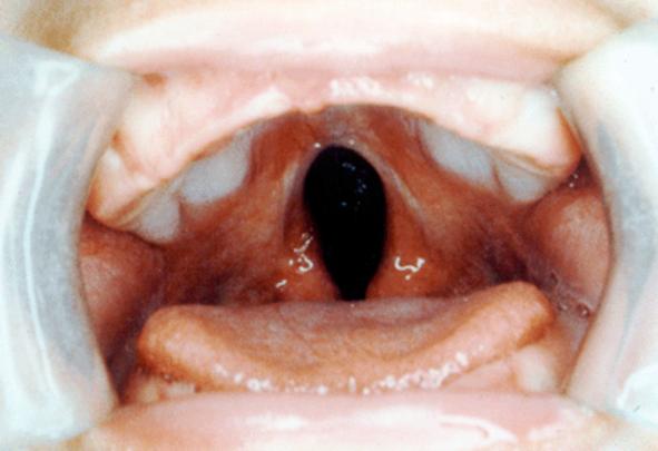 de São Paulo As fissuras de lábio e/ou palato (FL/P) são anomalias craniofaciais congênitas que podem ocorrer