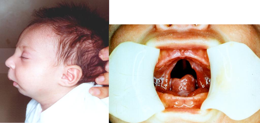 Fig 4. Lactente com Seqüência de Pierre Robin, caracterizada por micrognatia e glossoptose, com ou sem fissura de palato.