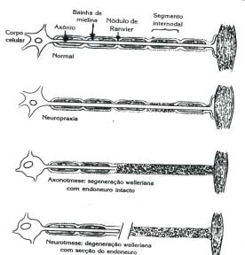 5. Classificação das Lesões nervosas periféricas Segundo Seddon (1984), existem predominantemente três tipos de lesões das fibras nervosas: neuropraxia, axonotmese e neurotmese.
