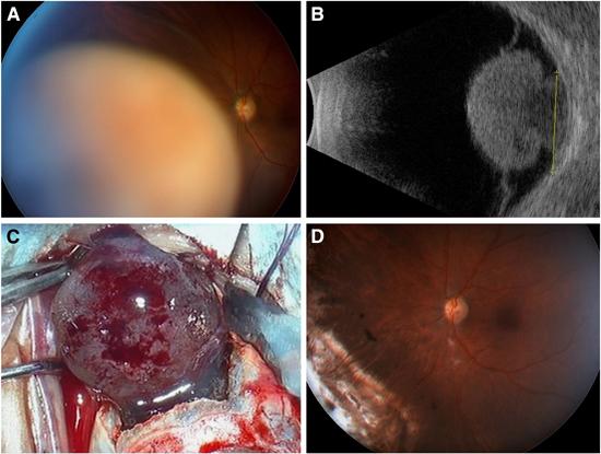 Braquiterapia Melanoma de Uvea Lesões maiores ressecção local seguido de braquiterapia adjuvante 44 anos A - Melanoma de coroide infero nasal OE B -