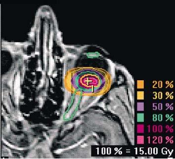 Melanoma de Uvea Radioterapia extereotáctica 60 Gy: 4 X 15 Gy Adequado controle local