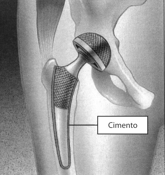 O que é artoplastia total de quadril Artroplastia total de quadril, também chamada de prótese total de quadril, é uma cirurgia que substitui as estruturas desgastadas do quadril com o objetivo de