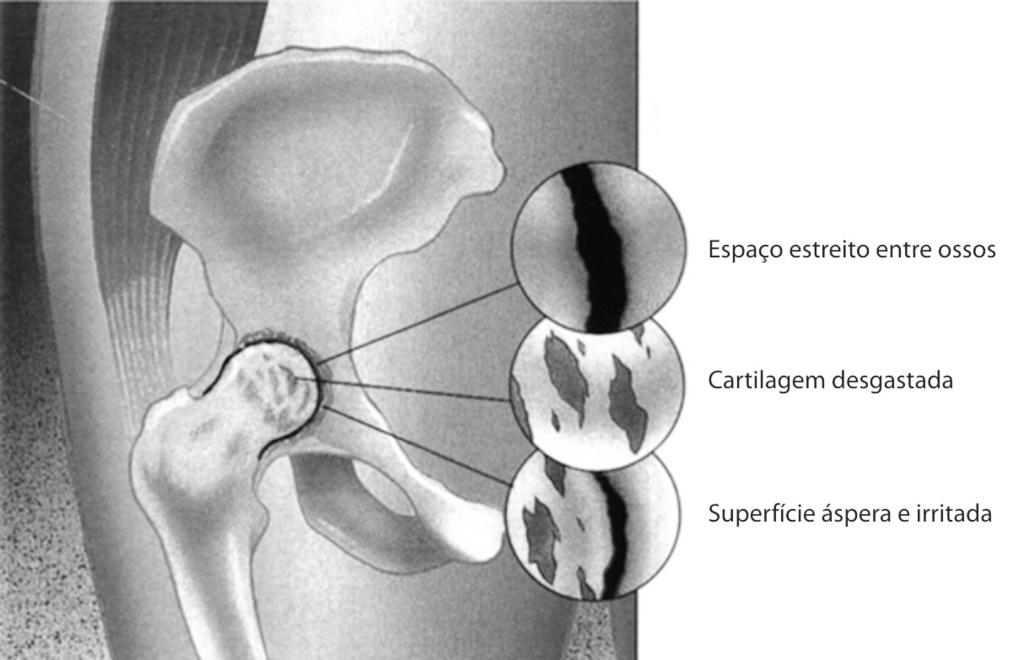 Artrite reumatóide: há uma inflamação crônica da articulação e produção excessiva de líquido dentro do espaço articular. A cartilagem pode ficar danificada, causando dor e rigidez.
