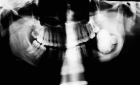 Radiograficamente, observou-se imagem radiopaca bem definida envolvendo o ângulo mandibular esquerdo, bem como parte do corpo e ramo da